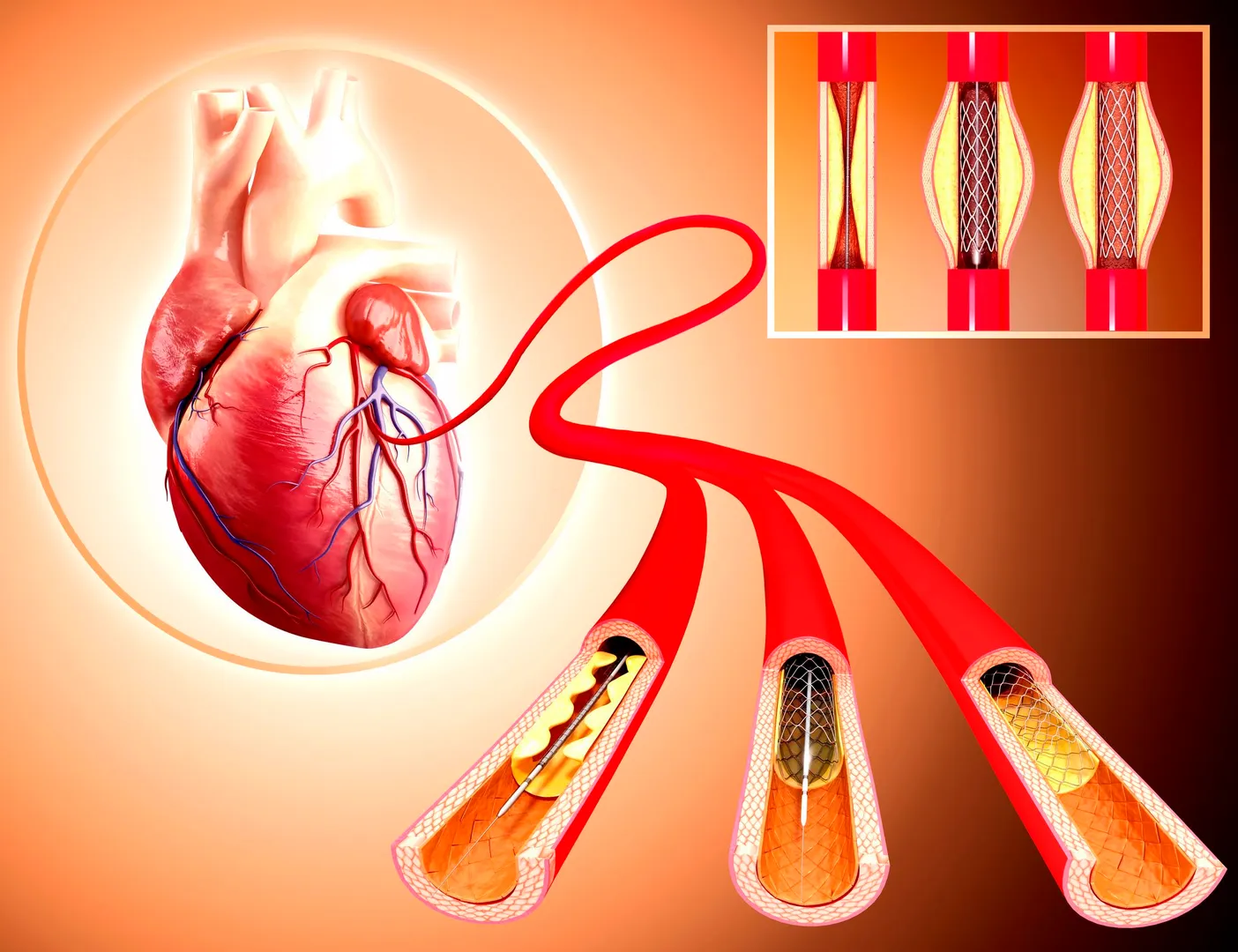 Coronary Angioplasty Hospital in PCMC,Pune image 1